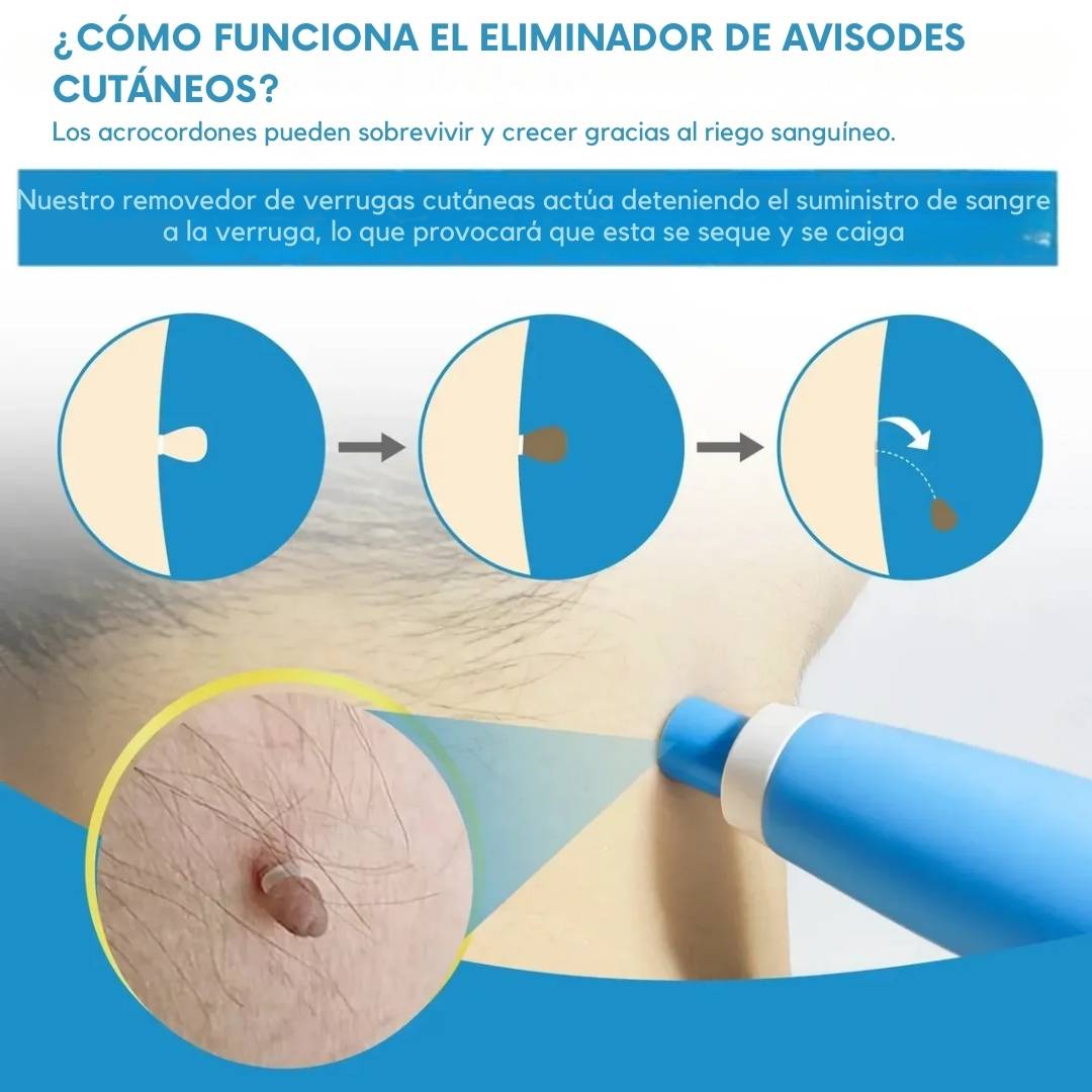Removedor de verrugas  SkinClean™ – ¡  fácil y seguro! ⚡